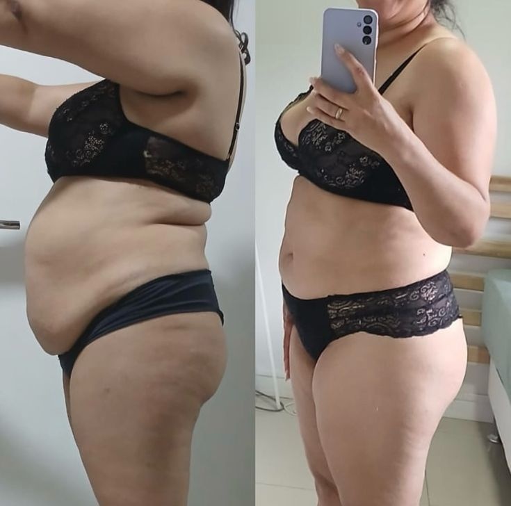 Reducción de abdomen y vientre plano